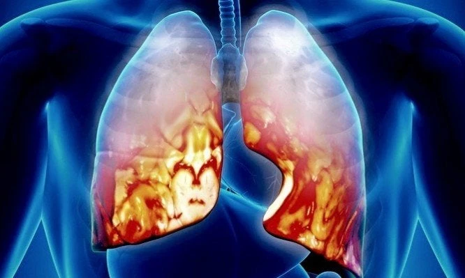 Πνευμονία: Τι πρέπει να προσέχεις στο «αθώο» κρυολόγημα – Ποια συμπτώματα πρέπει να σε ανησυχήσουν